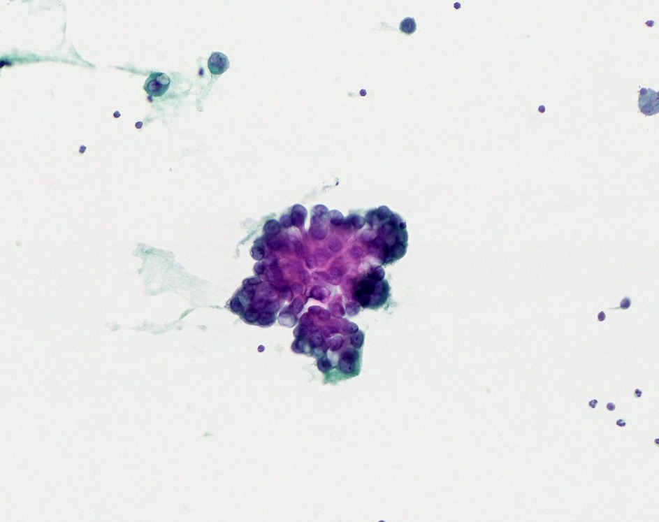 SCAP (@scapsome) on Twitter photo CAS 5 – DAVID PIÑOL (<a href="/APsantpau/">Anatomia Patològica Sant Pau</a>)
♂77a sense antecedents que presenta dispnea, tos i febrícula. RX tórax: vessament pleural basal dret. Es realitza punció pleural amb sortida de líquid exsudatiu.
<a href="/MoticPathEU/">Motic Europe Pathology Division</a> <a href="/MoticEurope/">Motic Europe</a> #scap2022 #MoticEasyScan #DigitalPathology #MoticFlow CAS 5 – DAVID PIÑOL (<a href="/APsantpau/">Anatomia Patològica Sant Pau</a>)
♂77a sense antecedents que presenta dispnea, tos i febrícula. RX tórax: vessament pleural basal dret. Es realitza punció pleural amb sortida de líquid exsudatiu.
<a href="/MoticPathEU/">Motic Europe Pathology Division</a> <a href="/MoticEurope/">Motic Europe</a> #scap2022 #MoticEasyScan #DigitalPathology #MoticFlow