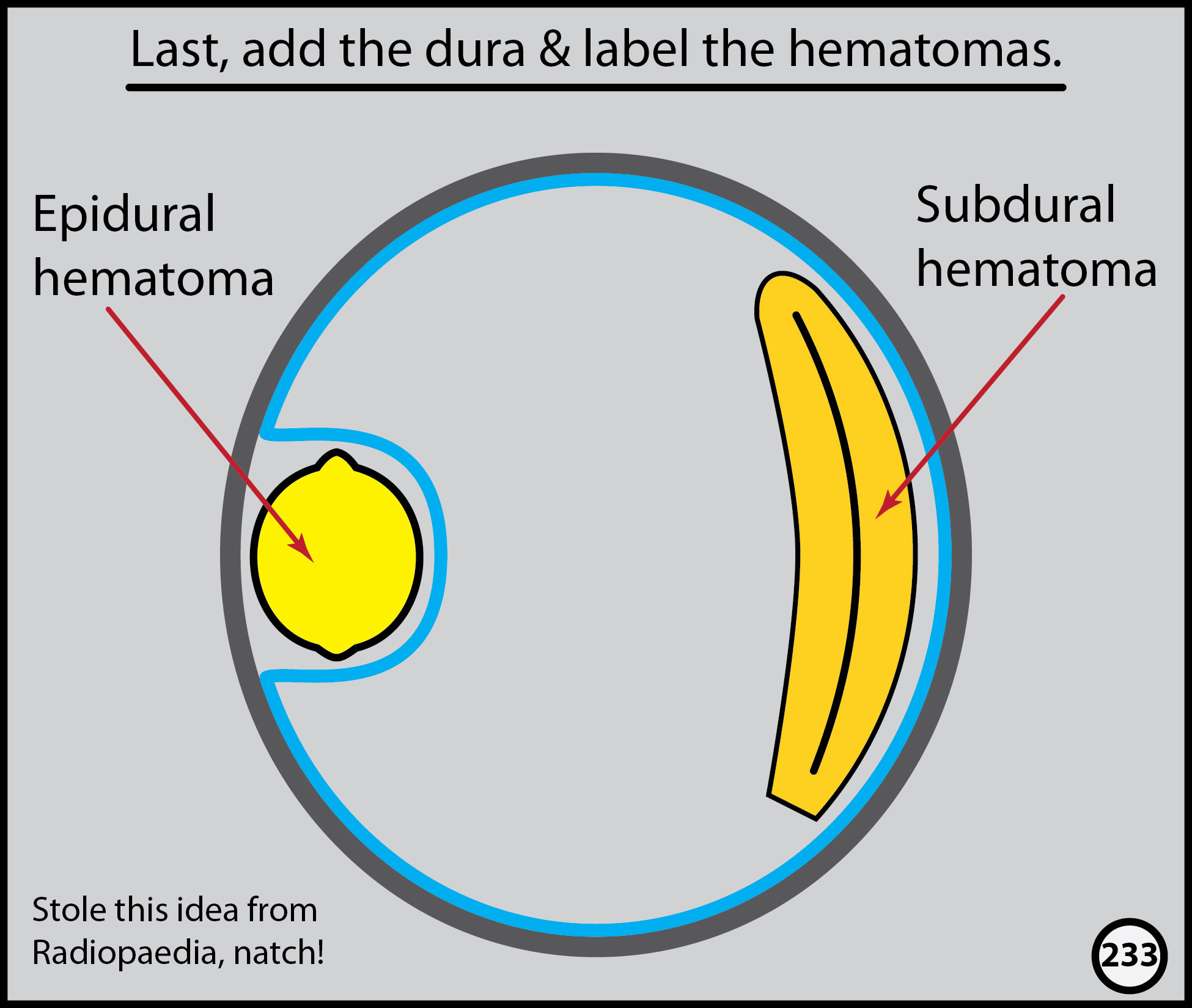 Subdural vs epidural hematoma raeannartin