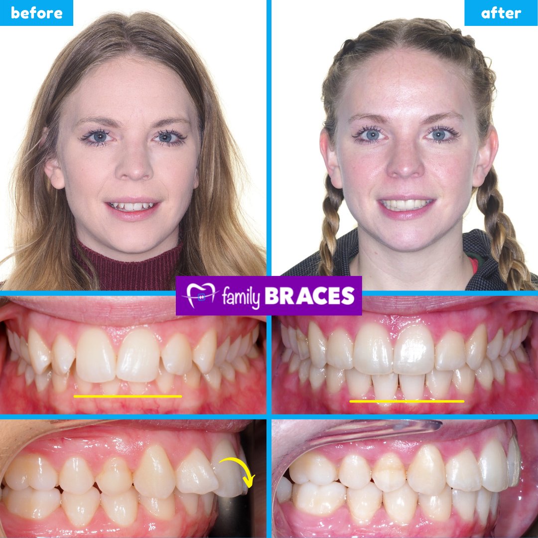 Deep Bite Invisalign