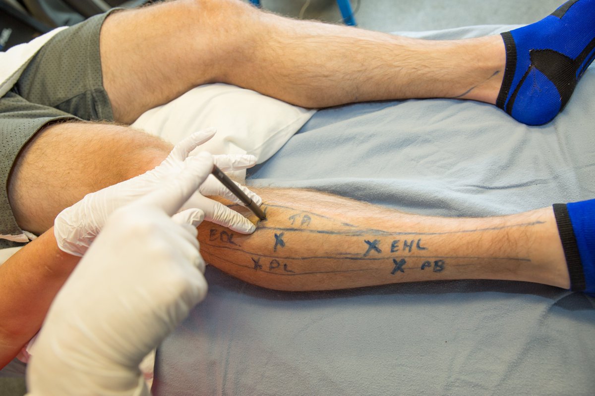 Acupuncture_Can's tweet photo. A last minute addition of our Dry Needling Level 1 course in St. John's, NL, April 1-3, 2022. Join us and add another fantastic treatment tool to your toolbox! https://t.co/NFyhuYMBHd https://t.co/3JgOCEyYMt
