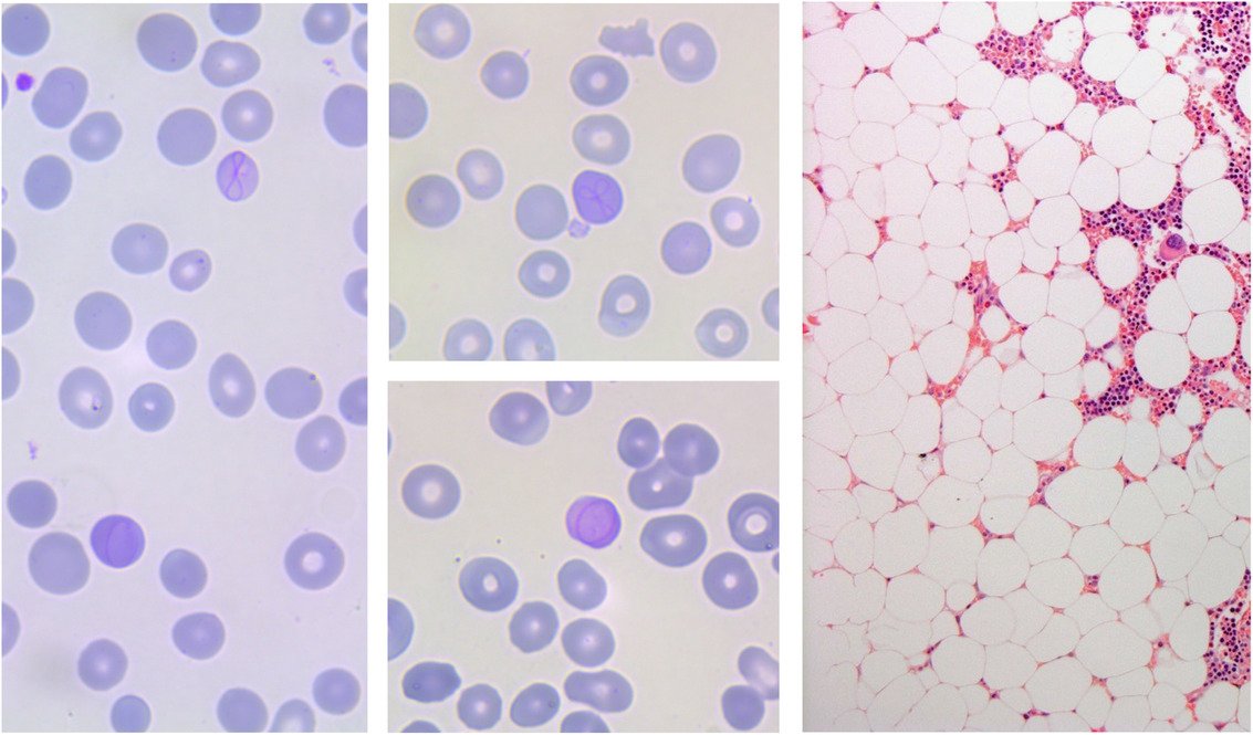 smbenlazar's tweet photo. Aplastic bone marrow with Cabot rings in blood due to high‐dose olmesartan https://t.co/t0aXar9vA5 https://t.co/4nw3mYXwUo