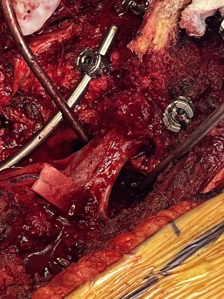 JeffreyHatef's tweet photo. Before the closure. #PSO @ViljoenMd @jennamakuch3 #spine #Neurosurgery https://t.co/nQ62OhyD81