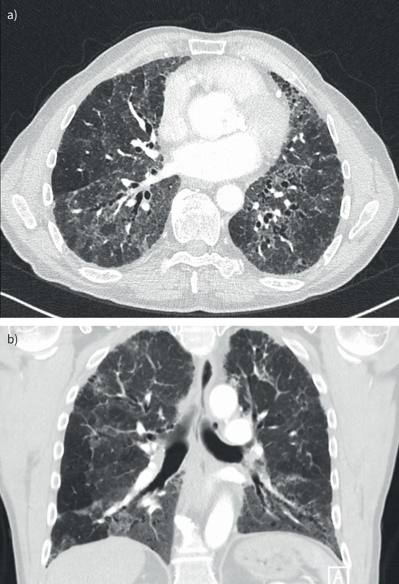 Guideline statements for the diagnosis of hypersensitivity pneumonitis have recently been published by the ATS/JRS/ALAT and CHEST. This review examines differences in the two guideline statements and discusses current management options. bit.ly/3o6uJh2