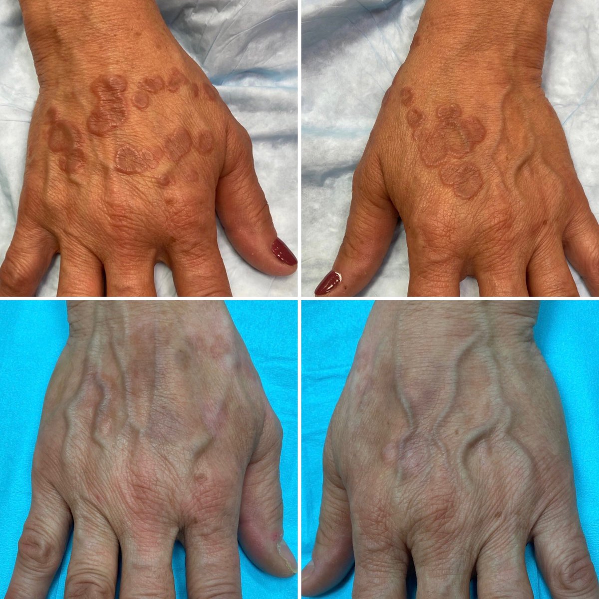 owe this to the amazing work by <a href="/billdamsky/">William Damsky MD, PhD</a> and his colleagues - they helped this pt significantly, many kudos to his team <a href="/yalederm/">Yale Dermatology</a> 👏🏽👏🏽👏🏽
response after 6 weeks of topical ruxolitinib!
#dermtwitter #dermatology