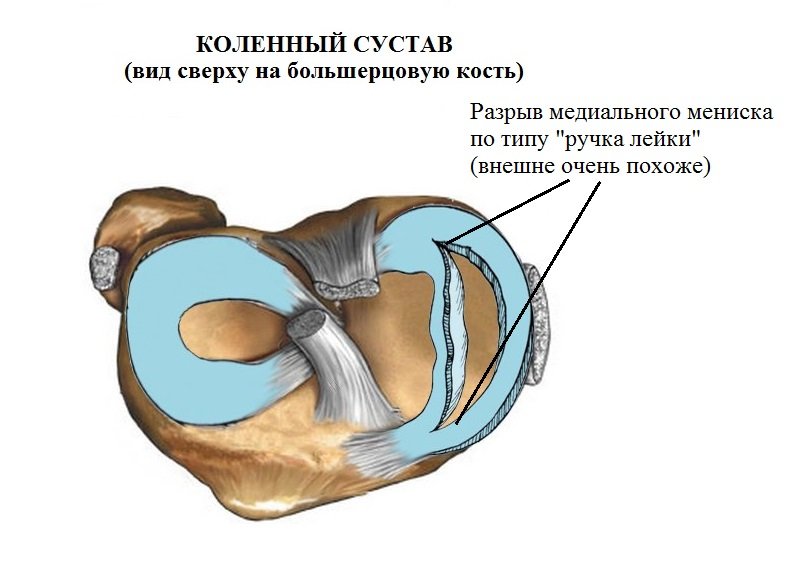 Структурные изменения мениска