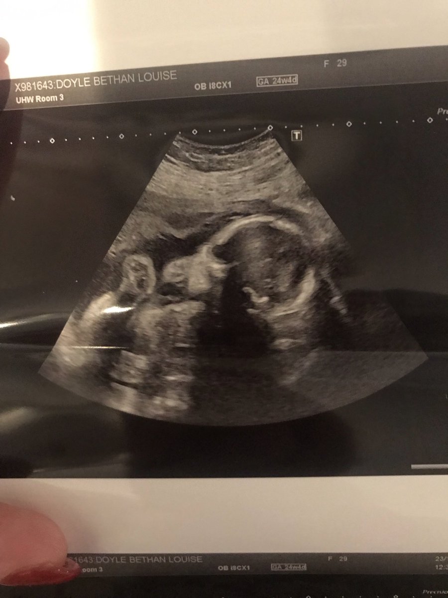 Bethaan92's tweet photo. We love you princess! Mammy and daddy can’t wait to meet you now!! Only 53 days till your due date!! #countdown #gettinguncomfortable #sheisworthit #cantwaittobeamamma 💖👶🏻🌏 https://t.co/rTTgrRreTd