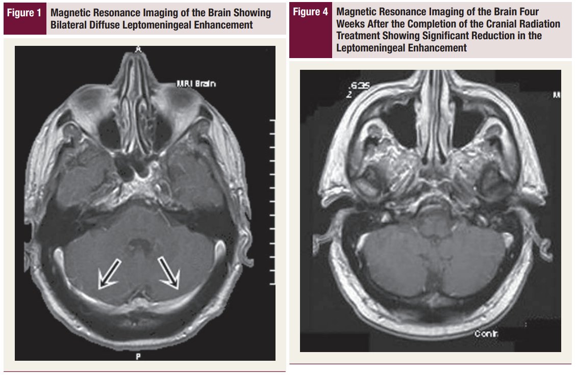 This #journalimage makes errors in describing/selecting the image and in annotation. There's no diffuse leptomeningeal enhancement. That's the transverse sinuses.

Case report without rads coauthors doi.org/10.3816/CLM.20…

h/t <a href="/drsuyash/">Suyash</a>