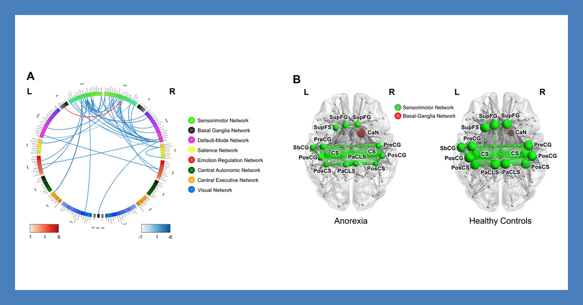 Arpana Church (@arpanachurch) on Twitter photo Our brain findings explain why #anorexianervosa pts have difficulty w/ body disconnection, hunger/fatigue, & experiencing reward. 🔖Journal of Eating Disorders pubmed.ncbi.nlm.nih.gov/35123579/ 🖊️<a href="/ravirbot/">Ravi R. Bhatt</a> <a href="/phkragel/">Philip Kragel</a> <a href="/LabusJS/">Jen Labus PhD</a> @emeranamayer & Zucker et al <a href="/UCLAHealth/">UCLA Health</a> <a href="/UCLA_BRI/">Brain Research Institute</a> <a href="/dgsomucla/">David Geffen School of Medicine at UCLA</a> Our brain findings explain why #anorexianervosa pts have difficulty w/ body disconnection, hunger/fatigue, & experiencing reward. 🔖Journal of Eating Disorders pubmed.ncbi.nlm.nih.gov/35123579/ 🖊️<a href="/ravirbot/">Ravi R. Bhatt</a> <a href="/phkragel/">Philip Kragel</a> <a href="/LabusJS/">Jen Labus PhD</a> @emeranamayer & Zucker et al <a href="/UCLAHealth/">UCLA Health</a> <a href="/UCLA_BRI/">Brain Research Institute</a> <a href="/dgsomucla/">David Geffen School of Medicine at UCLA</a>