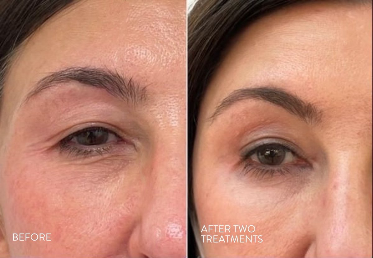This patient came to our practice looking to rejuvenate the delicate skin around her eyes. Using Venus Viva, a non-invasive treatment from <a href="/VenusTreatments/">Venus Treatments</a> we helped her accomplish her goal. Call Lancer Dermatology at 310-278-8444 to learn more about this innovative treatment.