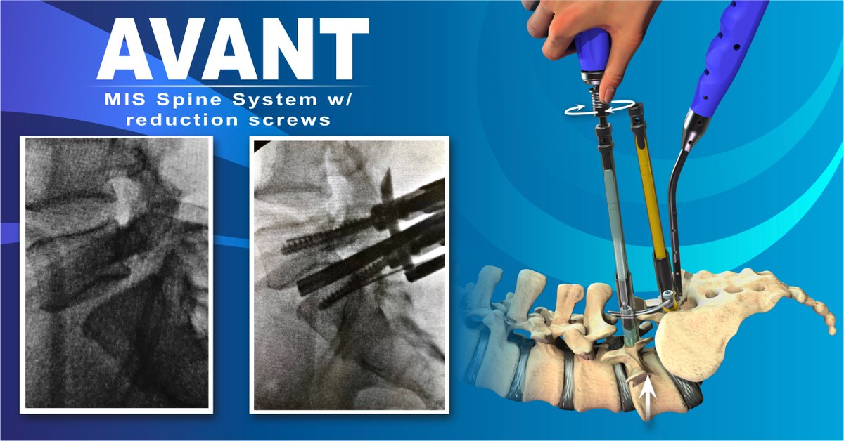 SpineCraft AVANT MIS Spine System with RCDF Technology, robust Reduction Screws and Three Rod Options. Request follow up here: spinecraft.com/contact-us.html