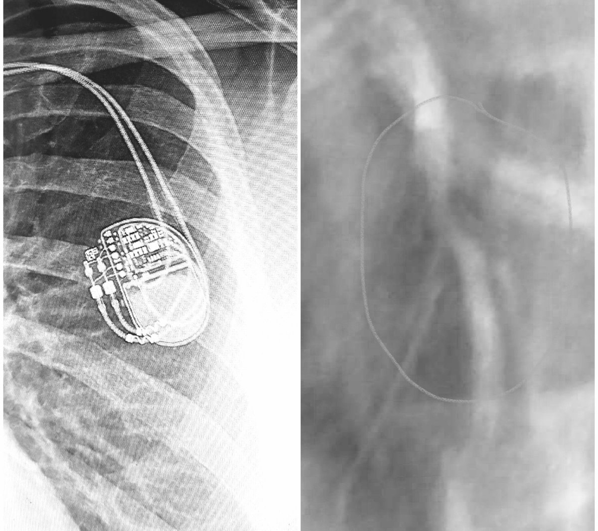ImprovEric's tweet photo. In recognition of #HeartMonth I want to thank the people in EMS, HEMS, FIRE, NURSES & CARDIOLOGISTS that have been a part of my life- โค #STEMI #WIDOMAKER #CODEBLUE #SICKSINUSSYNDROME #CHF #PACEMAKER #SURVIVOR https://t.co/peWQZEDKnh