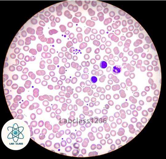 LabClass1206's tweet image. Linfocitos, segmentado, agregado plaquetario… 
¿Qué mas observas en la imagen? 

#hematologia #frotis #laboratorio #microscópio