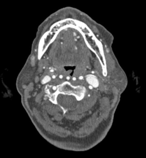 DrAndrewDixon's tweet image. 1, 2 , 3, 4… wait, what? 

radiopaedia.org/cases/97452 @Radiopaedia case by Dr Ahmed A. Khawwam