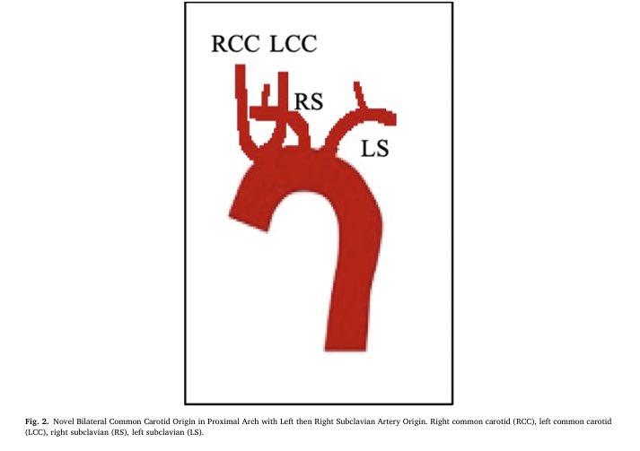 Eric Feldstein (@eric_feldstein) on Twitter photo Novel aortic arch variant: CCAs arising anteriorly from a common origin off the proximal aortic arch followed distally by the bilateral SCs. Illustration of the importance of obtaining preoperative imaging of the arch and great vessels
<a href="/nymcbrainspine/">Westchester Medical Center Neurosurgery</a>
<a href="/NeurologyNymc/">NYMC Department of Neurology</a> Novel aortic arch variant: CCAs arising anteriorly from a common origin off the proximal aortic arch followed distally by the bilateral SCs. Illustration of the importance of obtaining preoperative imaging of the arch and great vessels
<a href="/nymcbrainspine/">Westchester Medical Center Neurosurgery</a>
<a href="/NeurologyNymc/">NYMC Department of Neurology</a>