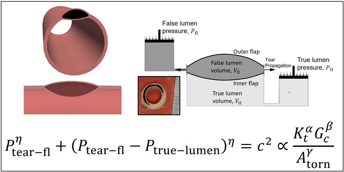 ABMEjournal's tweet photo. “Critical pressure of intramural delamination in aortic dissection,” @ehsan_ban_16 and @cris_cavinato of the Humphrey Lab @YaleBme 
@BMESociety @SpringerNature 

Link: https://t.co/7Hzl69RPLX https://t.co/qKDwN6tu02