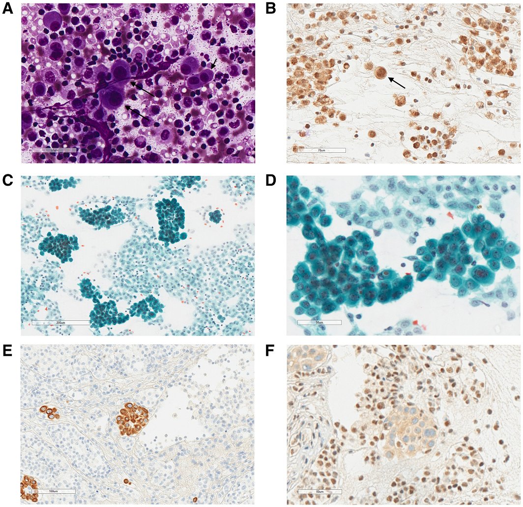 Abnormalities in cytomorphology, BAP1, and CDKN2A are present in pleural fluid specimens before the development of cytomorphologic features diagnostic of pleural mesothelioma. acsjournals.onlinelibrary.wiley.com/doi/full/10.10… #CytoPath