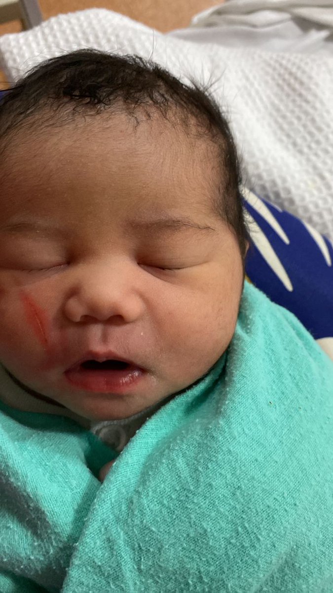 czarleea's tweet photo. @Khairykj @DGHisham @KKMPutrajaya @htjsn9 

Explainations needed to the red mark on the cheek of this baby...LSCS at HTJ around 11 s'thing this morning 17th Feb 2022. https://t.co/HA8x2wndmU