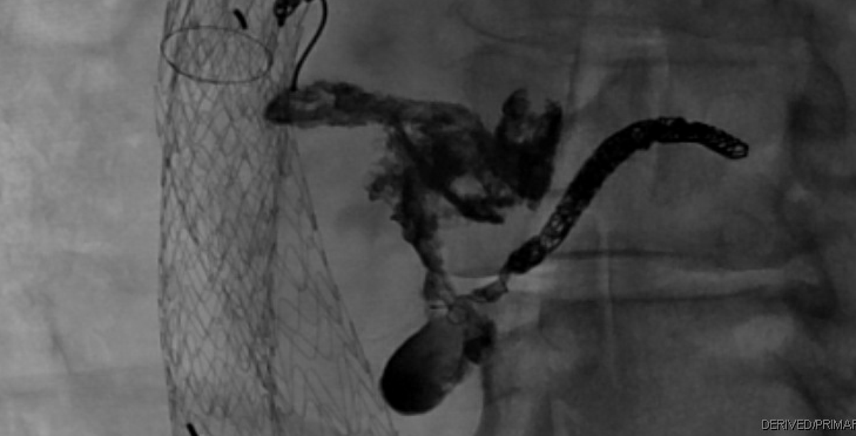 Did a great endoleak case today <a href="/AlbanyIR/">Albany IR</a> with <a href="/gsiskin/">Gary Siskin</a>...enlarging sac with new type II leak on CTA. Coil embolized the outflow lumbar artery and filled the space with EVOH! Excellent education on the principles of different embolics and when to use them!