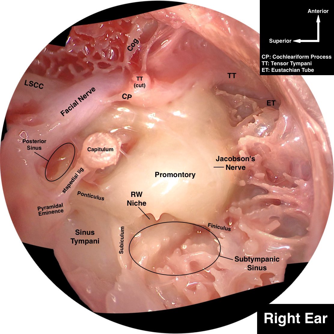 Olivia Kalmanson, MD, MS (@otolaryngolivia) on Twitter photo For #WorldHearingDay - I stitched together a series of endoscopic middle ear images to make a little panorama for trainees to prep for endoscopic ear cases! 1. TM removed, 2. TM+malleus+incus removed. <a href="/jsgolub/">Justin S. Golub</a> For #WorldHearingDay - I stitched together a series of endoscopic middle ear images to make a little panorama for trainees to prep for endoscopic ear cases! 1. TM removed, 2. TM+malleus+incus removed. <a href="/jsgolub/">Justin S. Golub</a>