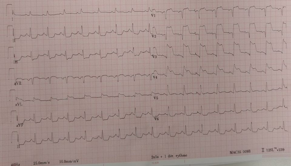 walinjom's tweet image. ACS - STEMI criteria:
- Chest pain ≥ 20 mins and
ECG in ≥ 2 contiguous leads:
1. ≥ 2.5mm ST ↑ in leads V2-3 in men &lt; 40 years
2. ≥ 2.0 mm ST ↑ in leads V2-3 in men &gt; 40 years
3. ≥ 1.5 mm ST ↑ in V2-3 in women
4. ≥ 1 mm ST ↑ in other leads
5. new LBBB