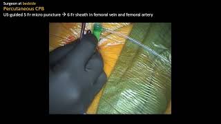 CTSNet (@ctsnetorg) on Twitter photo This video shows possibly the least invasive reported atrial myxoma resection and, the authors say, the first to use an endoscopic robotic approach with an 8mm working port.
By @Colin_C_Yost <a href="/jl_rosen/">Jake Rosen</a> <a href="/WuMeagan/">Meagan Wu</a> <a href="/CarolineKomlo/">Caroline Komlo, MD</a> @ether_intothe <a href="/sloaneguy/">T. Sloane Guy, MD, MBA</a>
ctsnet.org/article/endosc… This video shows possibly the least invasive reported atrial myxoma resection and, the authors say, the first to use an endoscopic robotic approach with an 8mm working port.
By @Colin_C_Yost <a href="/jl_rosen/">Jake Rosen</a> <a href="/WuMeagan/">Meagan Wu</a> <a href="/CarolineKomlo/">Caroline Komlo, MD</a> @ether_intothe <a href="/sloaneguy/">T. Sloane Guy, MD, MBA</a>
ctsnet.org/article/endosc…