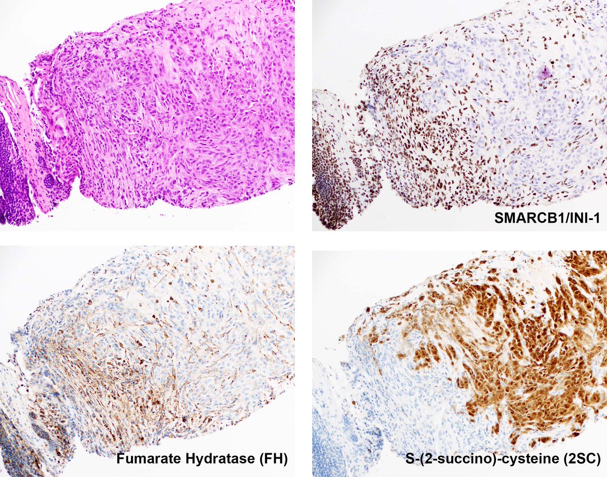 Renal Cell Carcinoma With Combined Loss of Fumarate Hydratase and SMARCB1/INI-1 CpG island methylator phenotype? mayoclinicproceedings.org/article/S0025-…