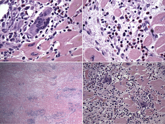 Yevgeniy Brailovsky DO MSc FACC (@yevgeniybr) on Twitter photo Giant cell myocarditis is often tough to diagnose and treat. We present a case of a fulminant myocarditis requiring bridge with 4 mechanical circulatory support devices to heart transplant
<a href="/JACCJournals/">JACC Journals</a>
<a href="/NirUrielMD/">Nir Uriel, MD MSc</a>
<a href="/EstefaniaOS/">Estefania Oliveros MD🫀</a>
#JACCcasereports
jacc.org/doi/10.1016/j.… Giant cell myocarditis is often tough to diagnose and treat. We present a case of a fulminant myocarditis requiring bridge with 4 mechanical circulatory support devices to heart transplant
<a href="/JACCJournals/">JACC Journals</a>
<a href="/NirUrielMD/">Nir Uriel, MD MSc</a>
<a href="/EstefaniaOS/">Estefania Oliveros MD🫀</a>
#JACCcasereports
jacc.org/doi/10.1016/j.…