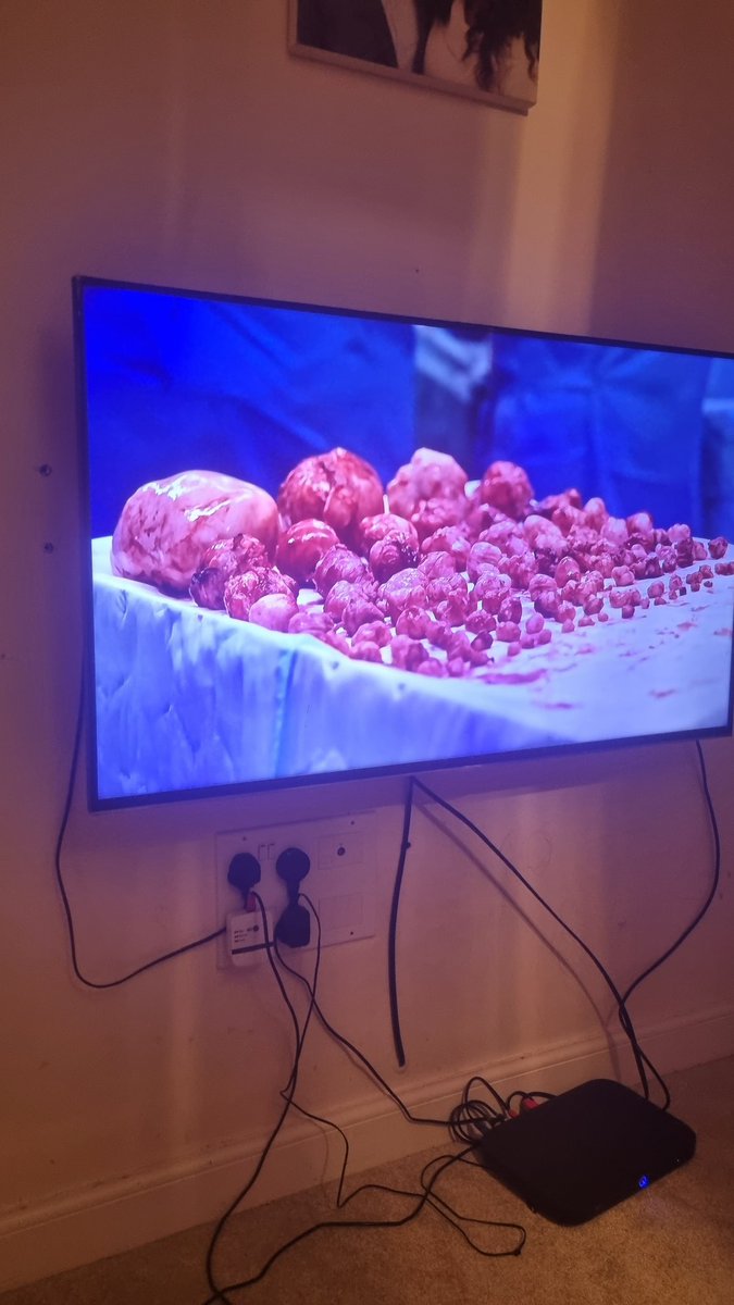 lualuaf's tweet photo. Dr Stephen Quin had performed magic! Over 100 fibroids removed successfully!
@Mammypi I can't thank the NHS enough!
#yourbodyuncovered #KateGarraway #BBCTwo #HildaNgelo #Uterine #Fibroids #FibroidsSurgery #MultipleFibroids https://t.co/gJgeO902nH