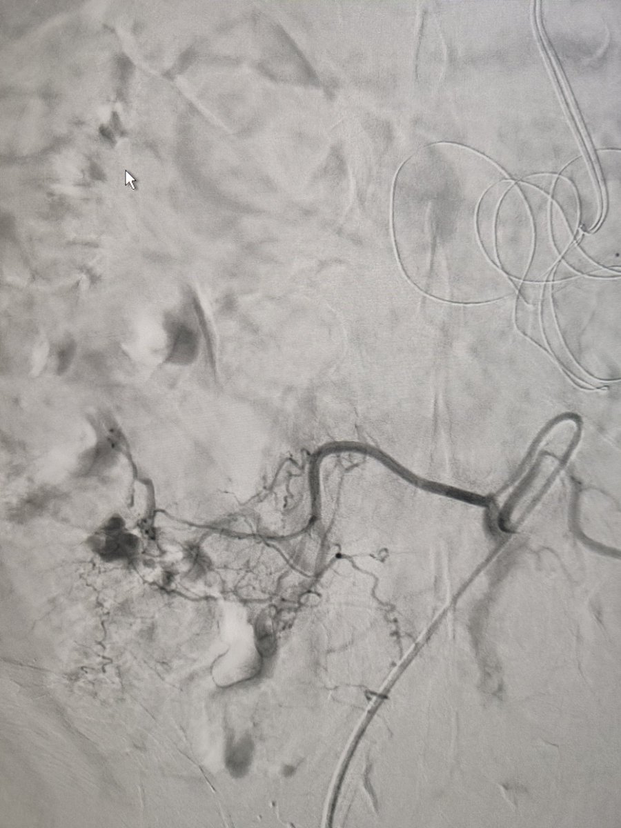 Dani92mr's tweet photo. Primera iliolumbar ipsilateral más lumbar derecha.
Todo glue! https://t.co/65YOEjBXsZ