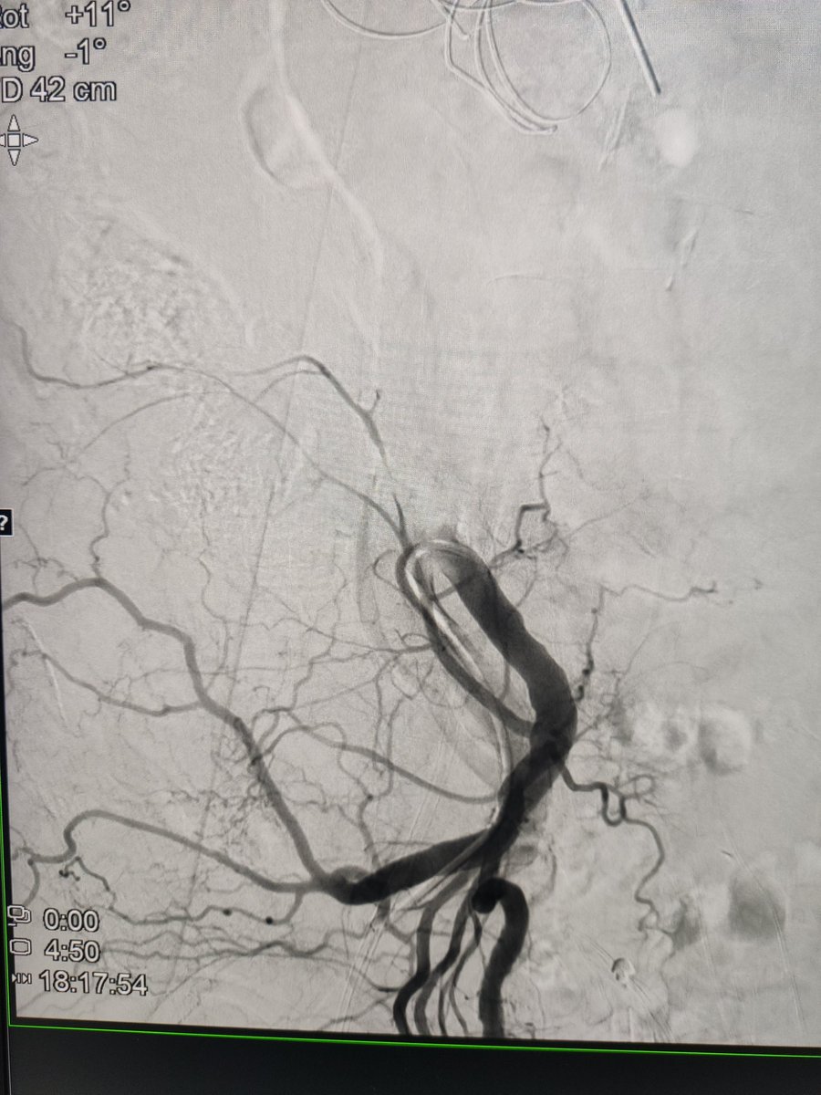 Dani92mr's tweet photo. Primera iliolumbar ipsilateral más lumbar derecha.
Todo glue! https://t.co/65YOEjBXsZ