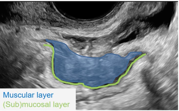 ISUOG's tweet photo. As part of March's #endometriosis month, the #VISUOG chapter on Deep Endometriosis is open access for all of February. Access the chapter here: https://t.co/nA2XlmiWEu #ISUOG #LoveUltrasound https://t.co/fLpKTEPCij
