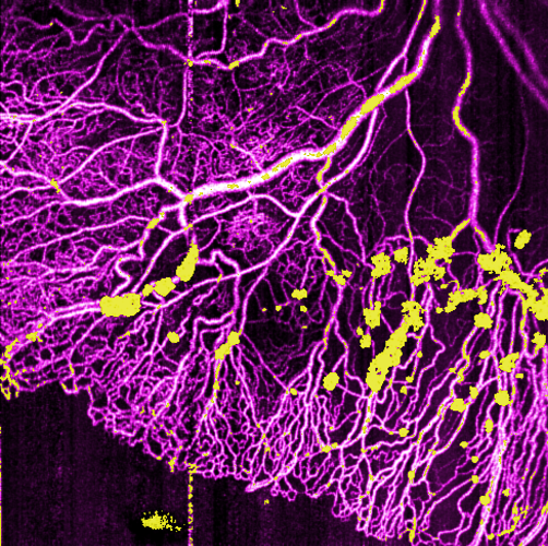 “Current #OCT systems get hundreds of thousands of axial scans per second, making it feasible to image wide areas of the retina with ultrawide-field OCT systems. Several of our faculty are working on different applications.' - Dr. David Huang bit.ly/3vqcTd2 #ohsu #OCTA