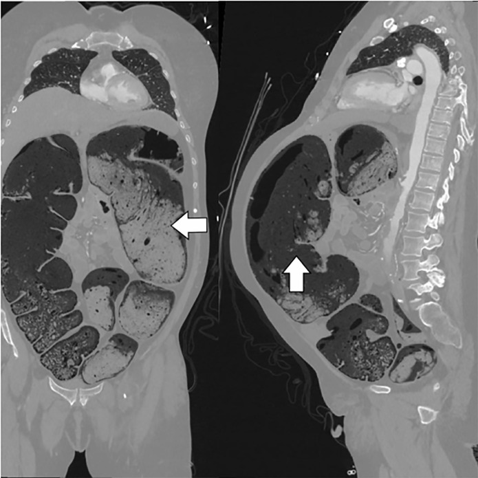 KewinSiah's tweet photo. Chronic constipation is not always benign.
Fatal Abdo Compartment Syndrome Due to #Constipation: 64 y/o 🧓🏽 presented to the ED with a protuberant abdomen. CT showed a 💩-filled colon with a decompressed IVC
#stoolcankill 2.
#GITwitter #MedTwitter
https://t.co/grgonyyaBY https://t.co/3YPs3bzw2s