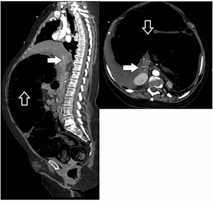 KewinSiah's tweet photo. Chronic constipation is not always benign.
Fatal Abdo Compartment Syndrome Due to #Constipation: 64 y/o 🧓🏽 presented to the ED with a protuberant abdomen. CT showed a 💩-filled colon with a decompressed IVC
#stoolcankill 2.
#GITwitter #MedTwitter
https://t.co/grgonyyaBY https://t.co/3YPs3bzw2s