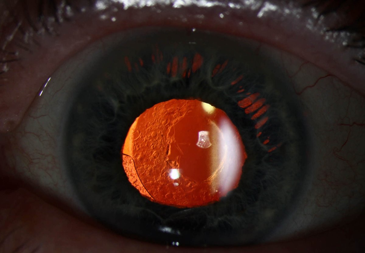 revoptom's tweet photo. Non-ophthalmologists Can Perform YAG Capsulotomies, Too 👍
This study found no change in outcome or complication rate when the operator was an advanced nurse practitioner.

https://t.co/ocVd8IvhLd https://t.co/R1AaGpKpun