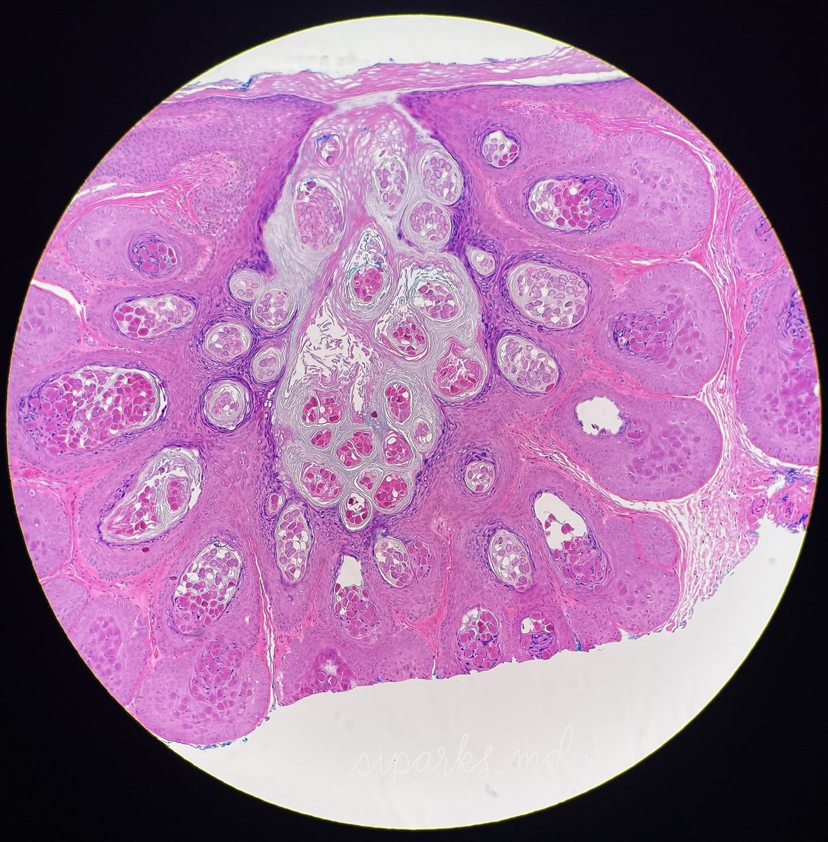 siparksmd's tweet photo. 🔬Hyalinized molluscum bodies (aka Henderson Patterson bodies) are large eosinophilic intracytoplasmic viral inclusions which are #pathognomonic for molluscum contagiosum

#PathTwitter #dermatopathology https://t.co/EbohQWazVT