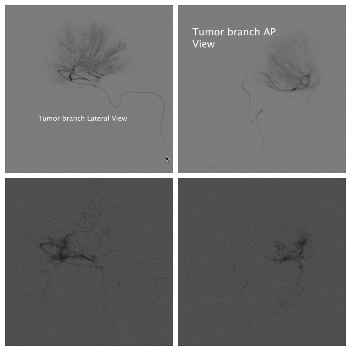David Altschul (@davidaltschulmd) on Twitter photo #masterclass #tumor #embo from ethmoidal branches of ophthalmic artery. Deep understanding of vascular anatomy essential to safe treatment. Some say not worth the risk. However with expanded endonasal approach tumor embo can have a real benefit. Thx <a href="/neuroangio1/">Neuroangio</a> for advice. #masterclass #tumor #embo from ethmoidal branches of ophthalmic artery. Deep understanding of vascular anatomy essential to safe treatment. Some say not worth the risk. However with expanded endonasal approach tumor embo can have a real benefit. Thx <a href="/neuroangio1/">Neuroangio</a> for advice.