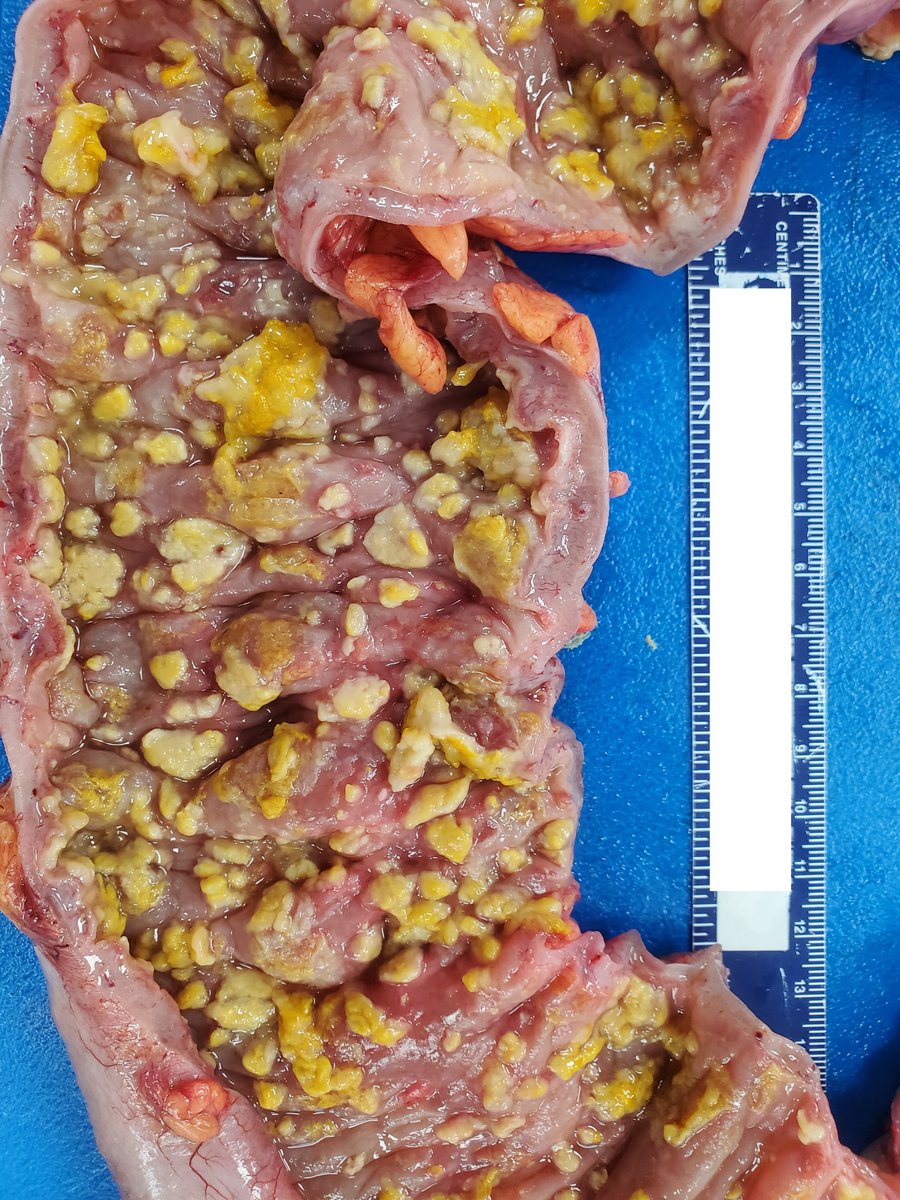 Total colectomy: Which organism most likely caused this?🧐 #pathtwitter #medtwitter #surgpath #GIpath #medicine #infectious #microbiology #pathboards #residenteducation <a href="/EinsteinPath/">Einstein Montefiore Pathology</a> <a href="/Dr_Brian_Cox/">Brian Cox, MD, MAS</a> <a href="/DrVish/">Vish Killari MD MPH</a> <a href="/omarham58651292/">omar hamdan</a> <a href="/yokoda_md/">Raquel Yokoda, MD</a> <a href="/MELanocyteMD/">Melanie Bourgeau, MD</a> <a href="/anjuthevirgo/">Anju Pandey</a>