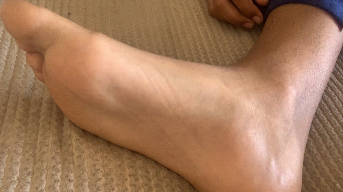 Brunette20tw's tweet photo. I NEED A MASSAGE FOR THESE BADIES #feetfinder https://t.co/DJ6SDMLCGk