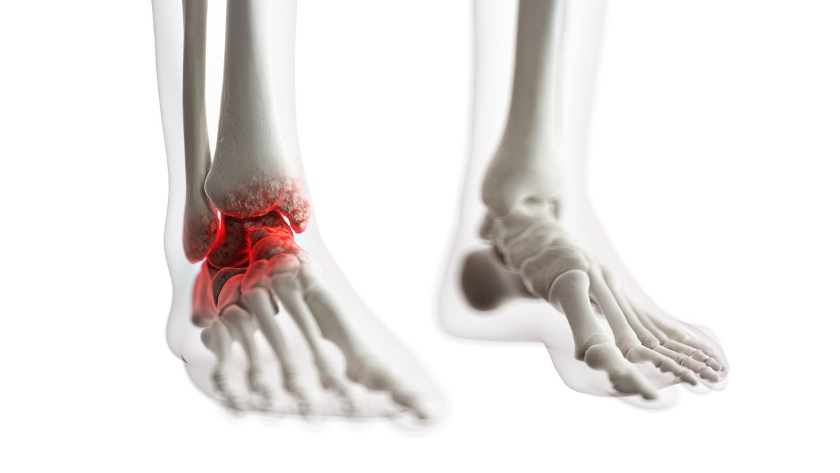 dynamichealthje's tweet image. Had an ankle sprain? Make sure to rehab it properly - in a 10-year follow-up of patients suffering ankle sprains, 72% showed signs of arthritis in the ankle joint.  

#FootPain #FootFunction #InjuryPrevention #Chiropractic #Physio #Osteopathy #DynamicHealth #JerseyCI