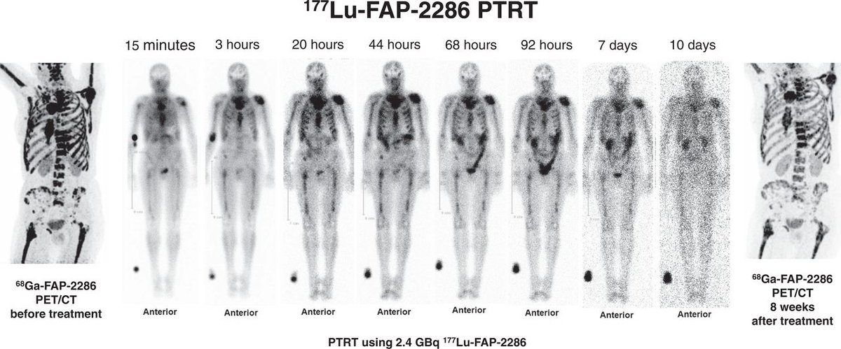 First-in-human results: ¹⁷⁷Lu-FAP-2286 PTRT, applied in a broad spectrum of cancers, was relatively well tolerated, with acceptable side effects, and demonstrated long retention of the radiopeptide. ow.ly/xZKK50I8nQS 

#MedicalResearch #NucMed #Cancer
