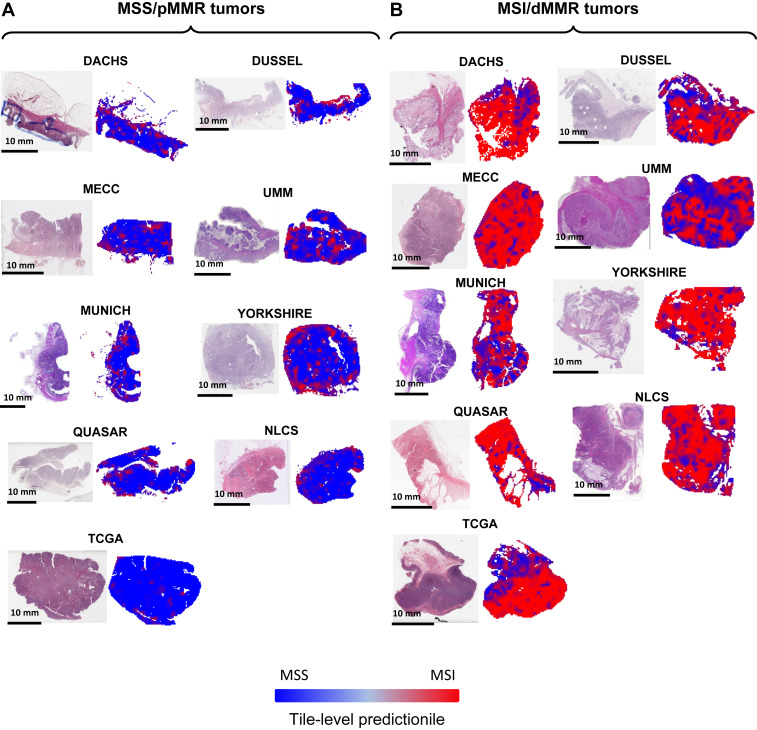 Jakob Nikolas Kather (@jnkath) on Twitter photo Our new paper is out <a href="/ESMO_Open/">ESMO Open</a>, by <a href="/a_echle/">Amelie Echle</a> <a href="/GhaffariNarmin/">Narmin Ghaffari Laleh</a> et al. We validate #AI for detection of #MSI in #colorectal #cancer. This is the largest such study to date (>8300 patients) and shows how to integrate this technology in diagnostic workflows sciencedirect.com/science/articl… Our new paper is out <a href="/ESMO_Open/">ESMO Open</a>, by <a href="/a_echle/">Amelie Echle</a> <a href="/GhaffariNarmin/">Narmin Ghaffari Laleh</a> et al. We validate #AI for detection of #MSI in #colorectal #cancer. This is the largest such study to date (>8300 patients) and shows how to integrate this technology in diagnostic workflows sciencedirect.com/science/articl…