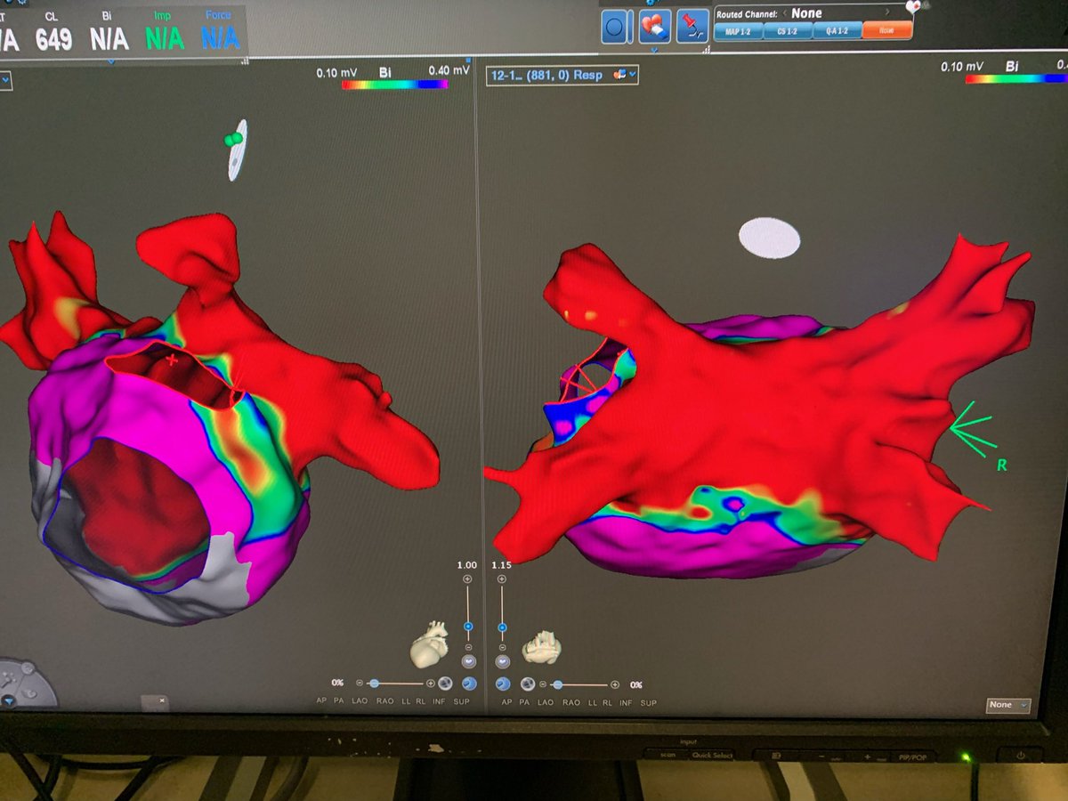 52 yo with 2 prior AF ablations in 2018, 6 months apart.  Presented to office in an AT.  Terminated on second burn at the roof. Thanks for the great map <a href="/EP_JB13/">John Burke</a> @BiosenseWebster