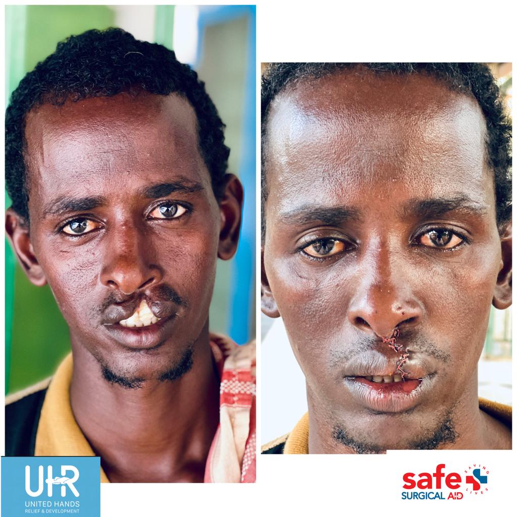 Pictures Of People With Aids Before And After