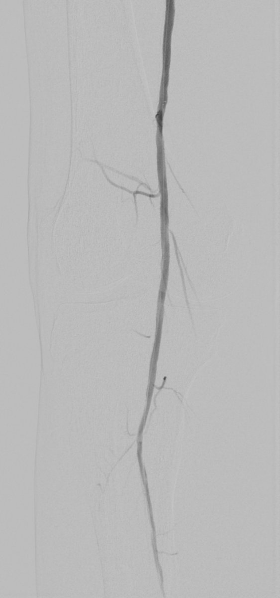 65 y/o with rest pain and total occlusion of SFA/stents and P1 reconstitution. Nice outcome with #rotarex, angioplasty and #lutonix DCB.

#rotarex 
#lutonix 
#bdpi
#bd
#PAD
#CLIFighters
#MTVIR
#irad 

@tex_smccall
@SIRspecialists
