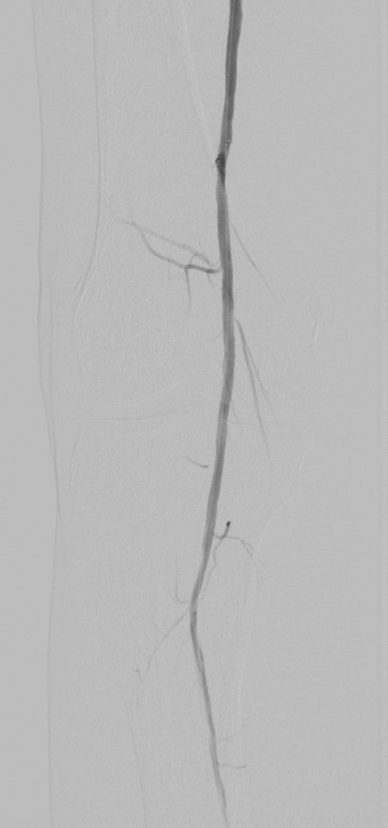 MTV_IR's tweet photo. 65 y/o with rest pain and total occlusion of SFA/stents and P1 reconstitution. Nice outcome with #rotarex, angioplasty and #lutonix DCB.

#rotarex 
#lutonix 
#bdpi
#bd
#PAD
#CLIFighters
#MTVIR
#irad 

@tex_smccall
@SIRspecialists https://t.co/Vx8DSrQhVi