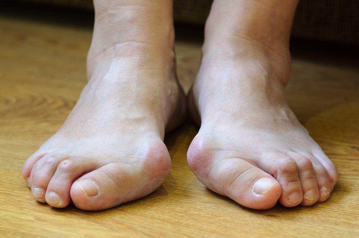 Investigate the preventative measures for bunions with our help! idahofoot.com/practice_areas…
