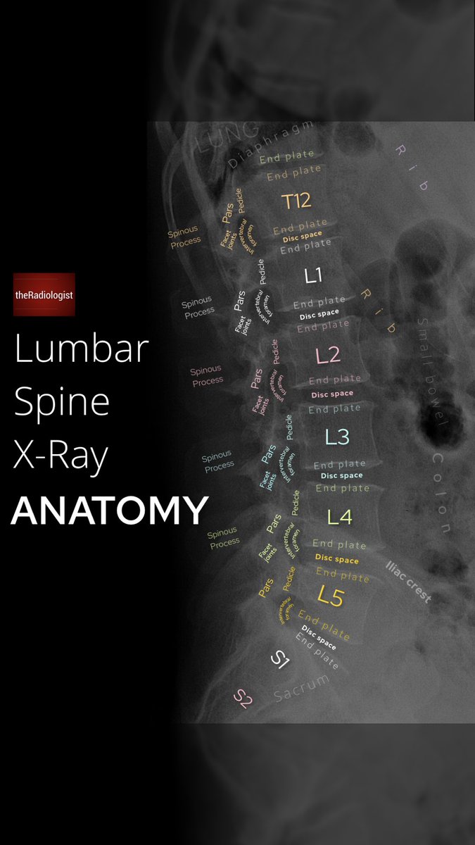 radiologistpage's tweet photo. Lateral lumbar spine X-ray anatomy https://t.co/BYZu8a7RAU