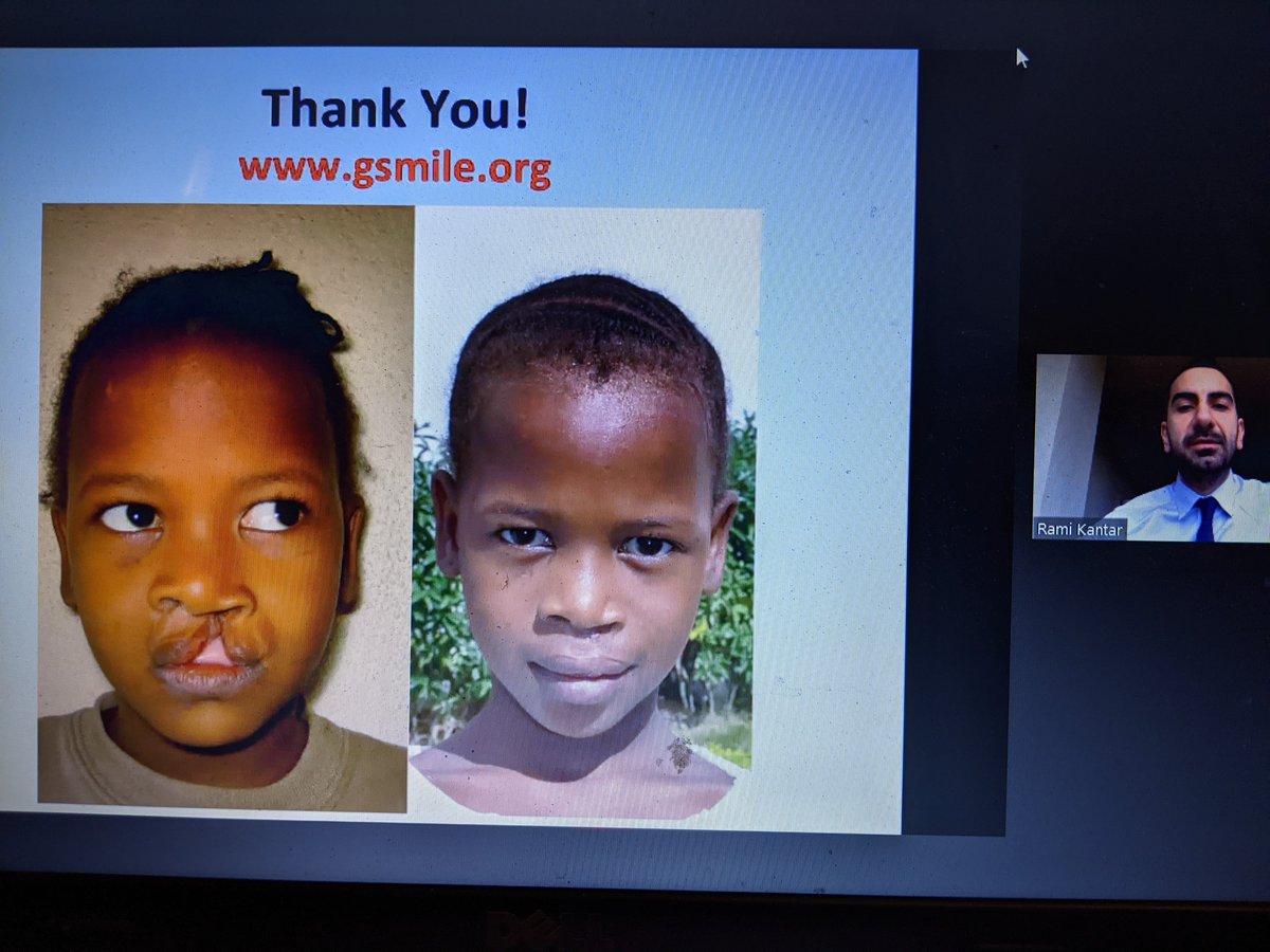 preeti_john's tweet photo. Inspirational grand rounds by @RamiKantar1 recipient of @AmCollSurgeons resident volunteerism award discussing topics such as #simulation based education #globalsurgery #diagonalapproach #internationaloutreach @RASACS https://t.co/o6m5cggL4T