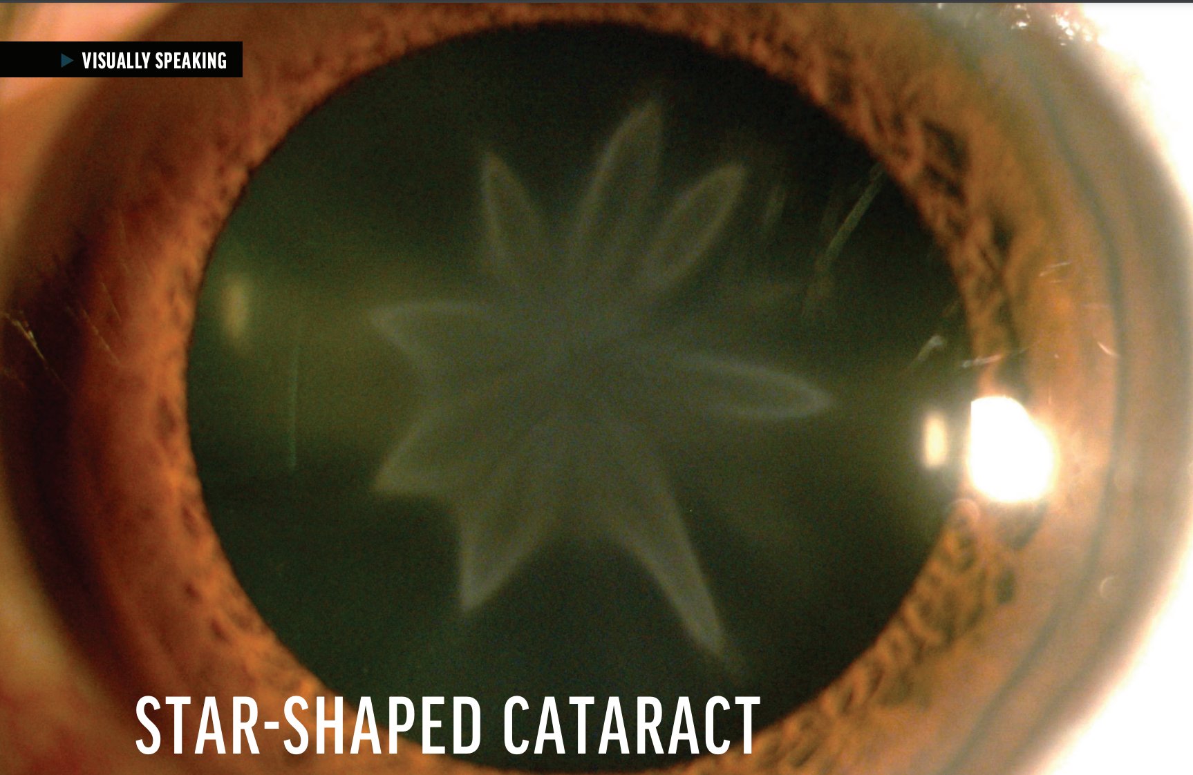 Cataract & Refractive Surgery Today on X: "A new case presentation and  pearls for managing rosette #cataracts: https://t.co/7RGiFVmDbe  https://t.co/a52JPFStve" / X